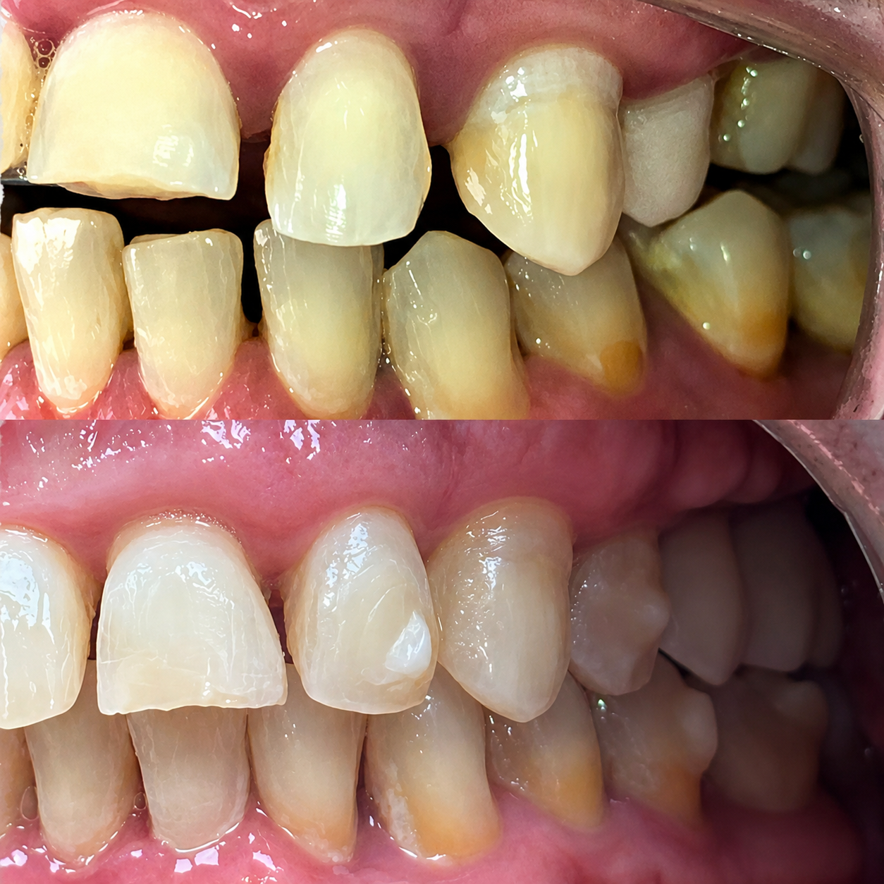 Antes e depois odontológico